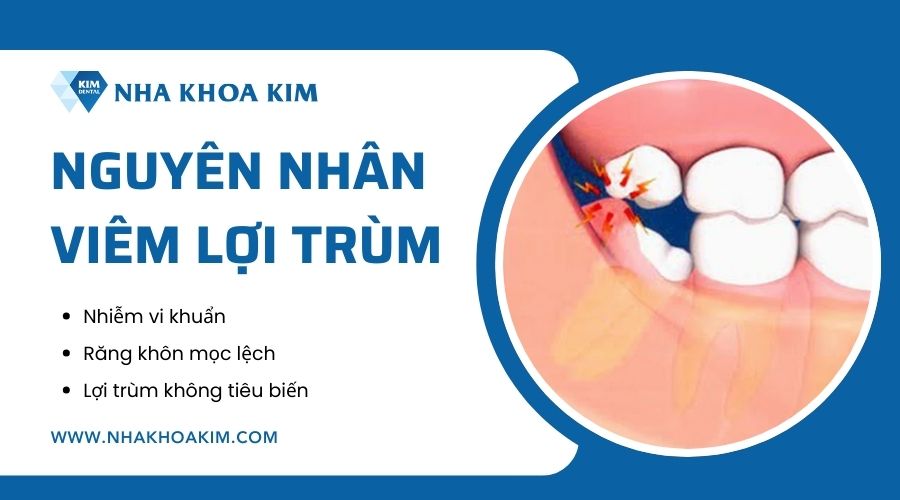 Nguyên nhân lợi trùm bị viêm