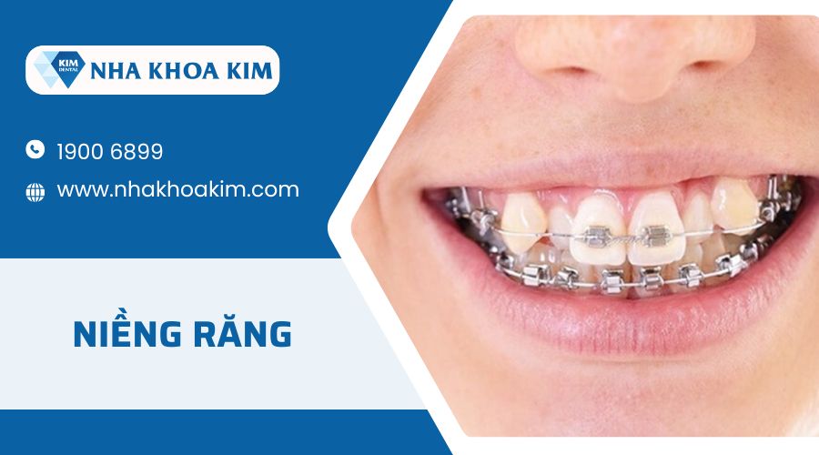 Niềng răng 9630