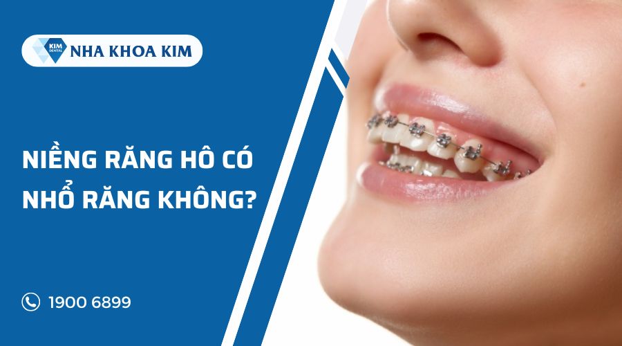 niềng răng hô có cần nhổ răng không