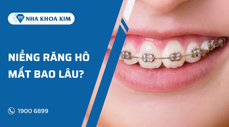 niềng răng hô mất bao lâu