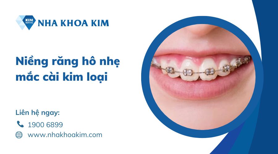 niềng răng hô nhẹ bằng mắc cài kim loại 