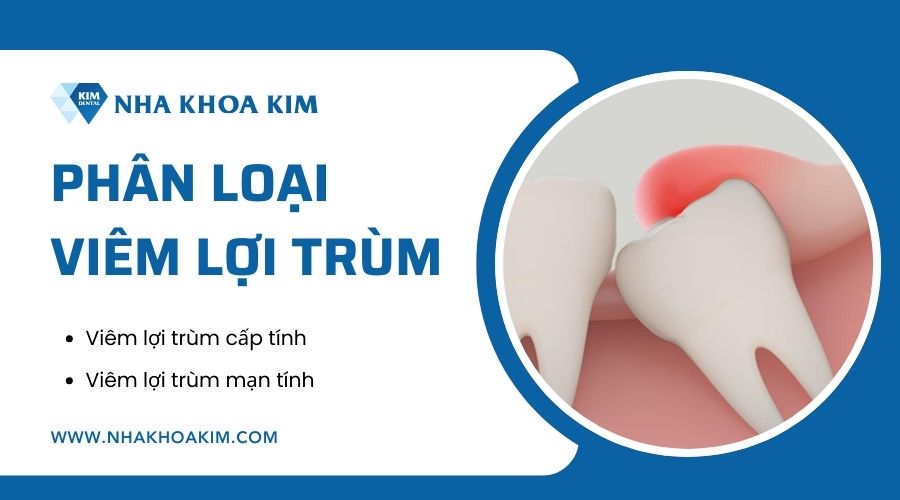Phân loại viêm lợi trùm