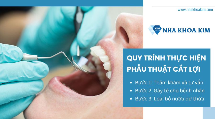 Quy trình phẫu thuật cắt lợi chuẩn y khoa