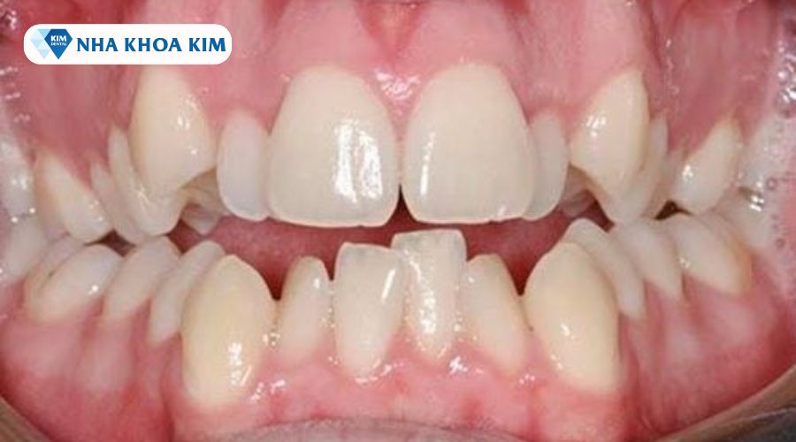 Hình ảnh nhận biết răng 9630