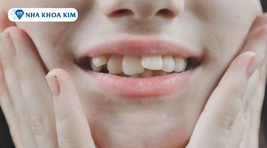 Hình ảnh răng mọc 9630 gây mất thẩm mỹ