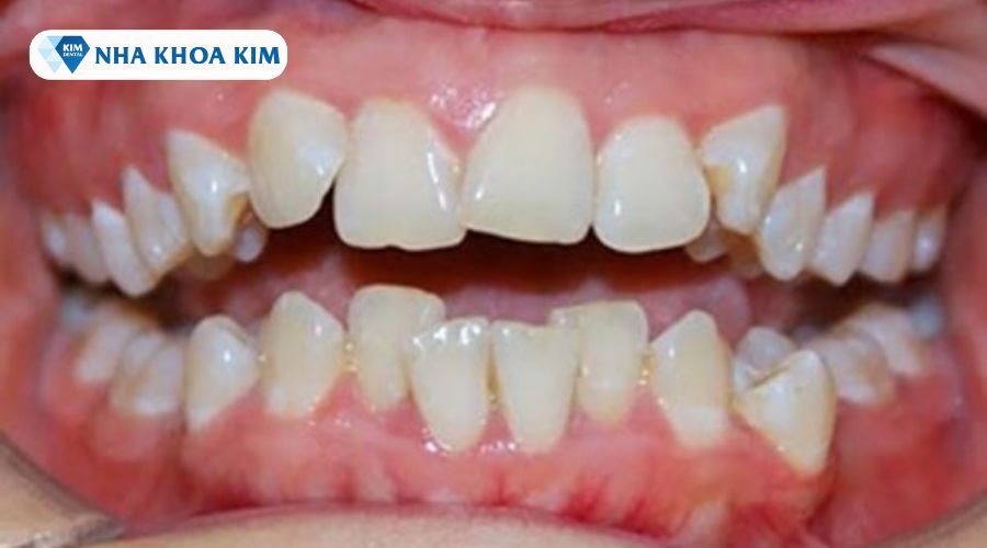 Hình ảnh răng bị 9630