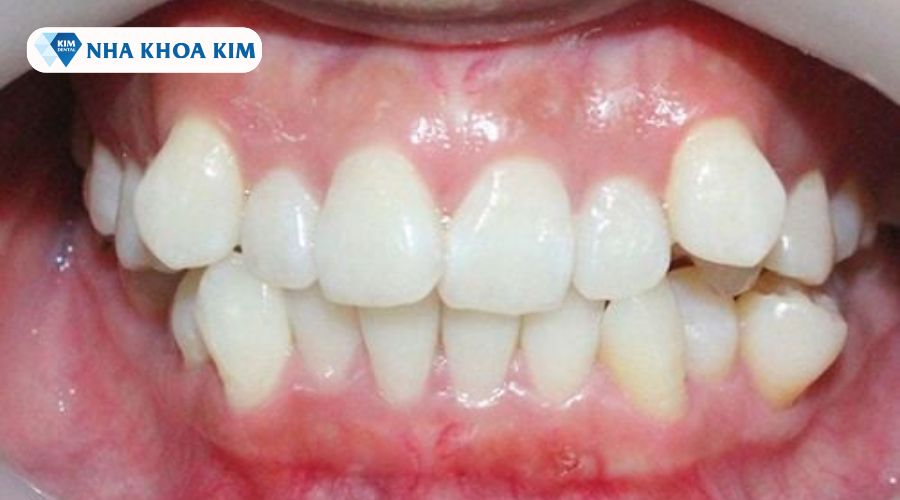 Hình ảnh răng 9630 mức độ nhẹ