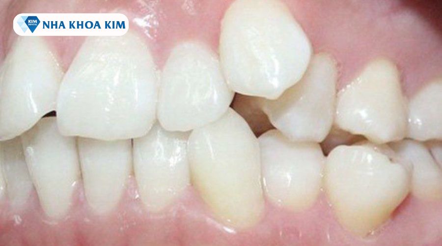 Hình ảnh răng mọc 9630