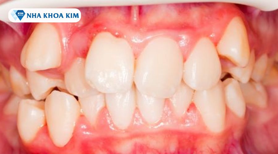 Hình ảnh răng mọc 9630 mức độ nặng