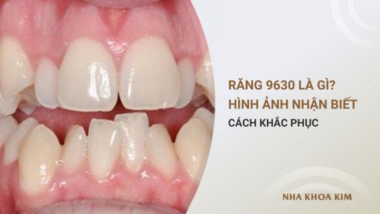 Răng 9630 là gì? Hình ảnh nhận biết và cách khắc phục