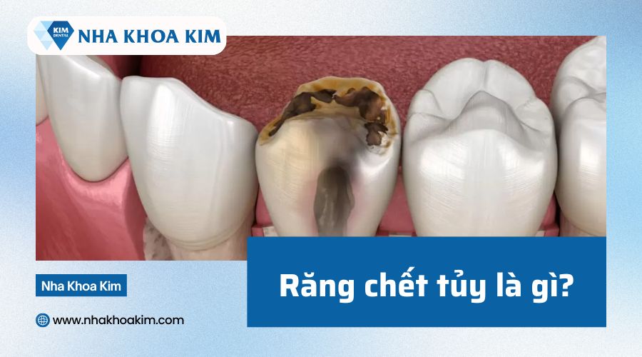 Răng chết tủy là gì?