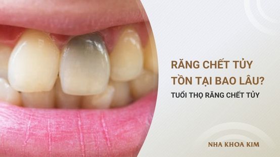 Răng chết tủy tồn tại được bao lâu? Tuổi thọ răng chết tủy