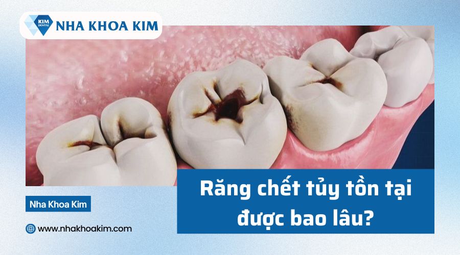 Răng chết tủy tồn tại được bao lâu?