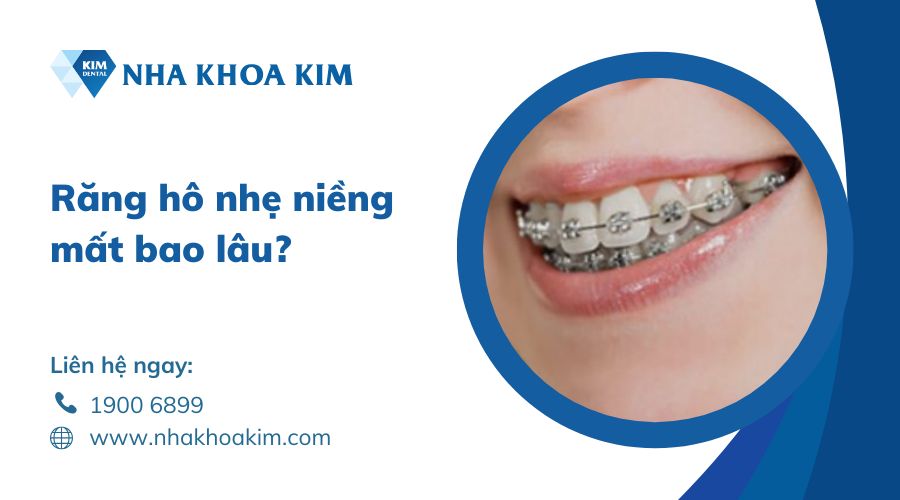 răng hô nhẹ niềng mất bao lâu