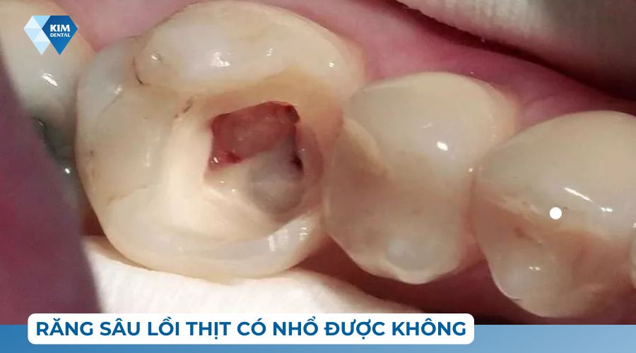 răng sâu lồi thịt có nhổ được không