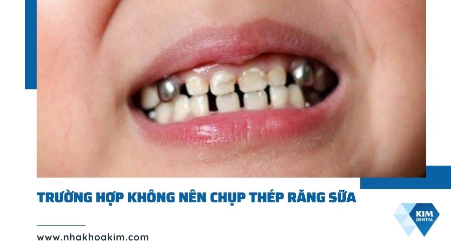 Trường hợp trẻ không nên chụp thép răng sữa