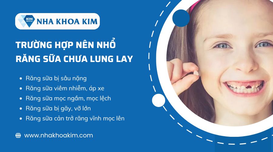 Nên nhổ răng sữa chưa lung lay khi nào?