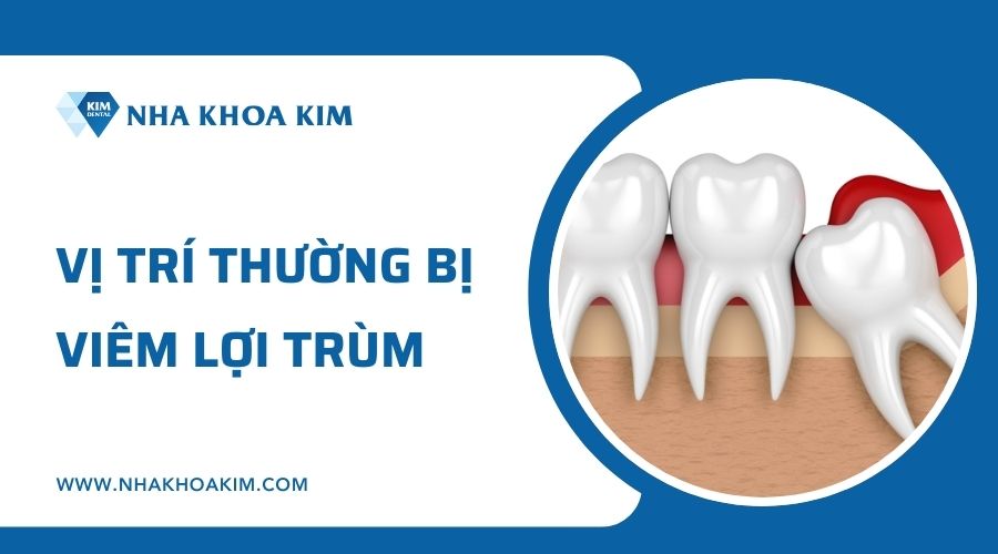 Vị trí thường bị viêm lợi trùm