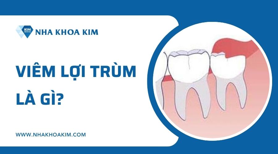 Viêm lợi trùm là gì?