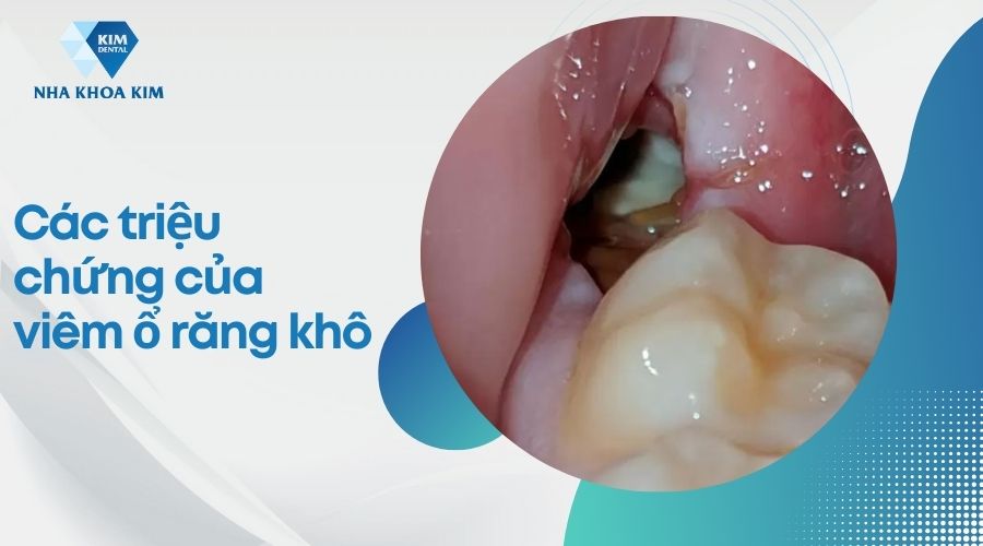triệu chứng của viêm ổ răng khô