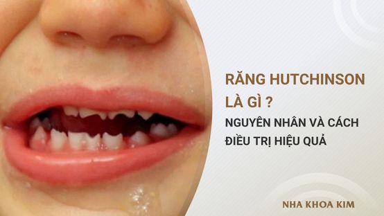 Răng Hutchinson là gì? Nguyên nhân và cách điều trị