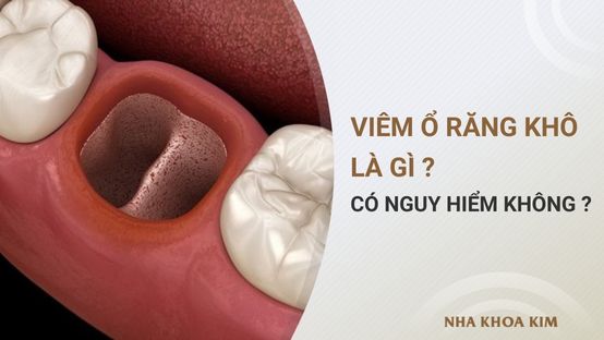 Viêm ổ răng khô là gì? Có nguy hiểm không?