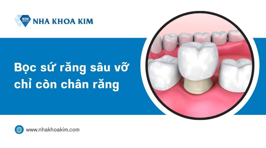 chữa răng sâu bị vỡ hiệu quả bằng phương pháp bọc sứ