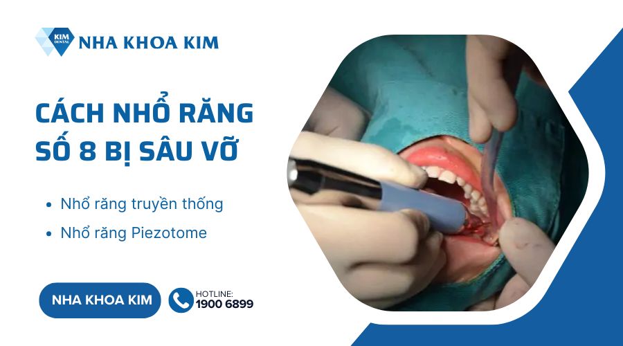 Cách nhổ bỏ răng sâu số 8