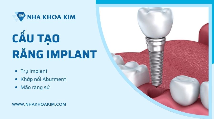 cấu tạo răng implant