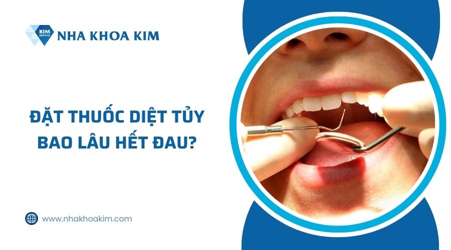 đặt thuốc diệt tủy bao lâu hết đau