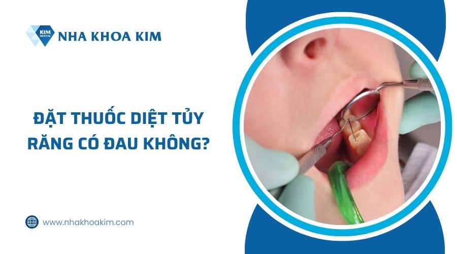 đặt thuốc diệt tủy có đau không?