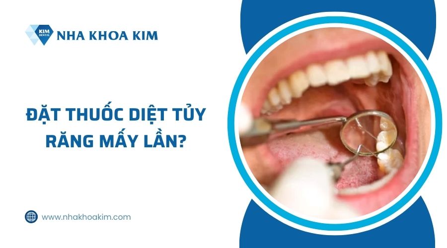 đặt thuốc diệt tủy răng mấy lần
