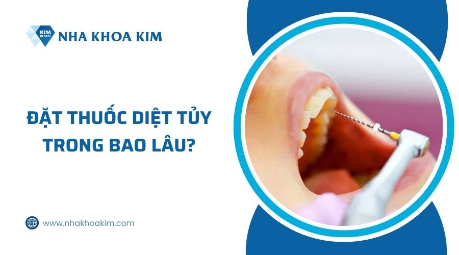 nên đặt thuốc diệt tủy răng trong bao lâu?