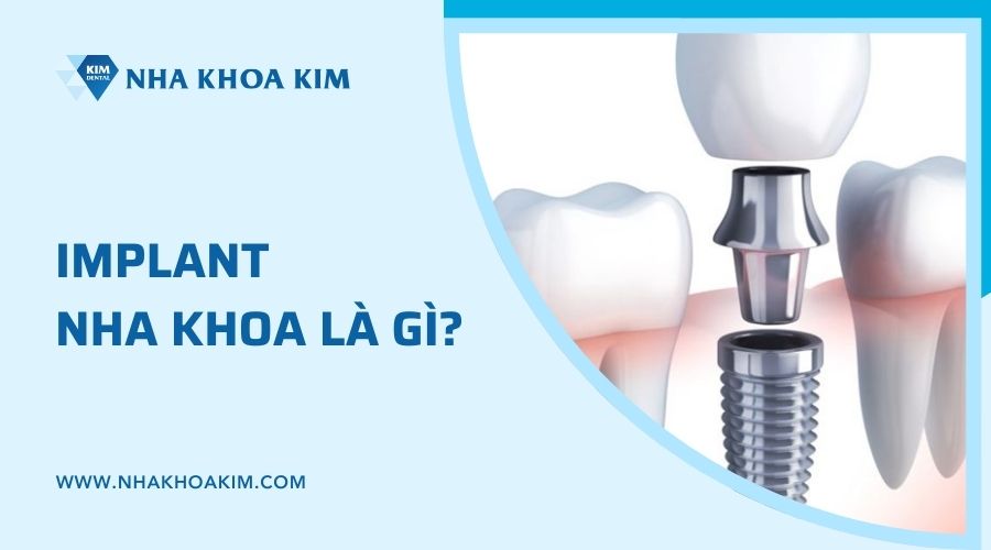 implant nha khoa là gì?