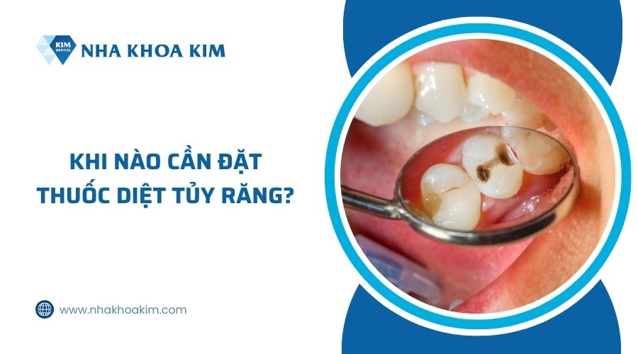 Khi nào cần đặt thuốc diệt tủy răng?