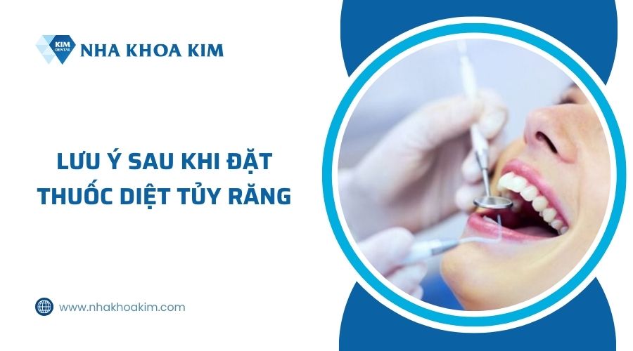 lưu ý sau khi đặt thuốc diệt tủy