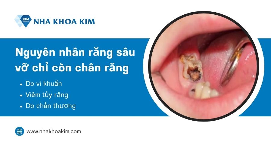 nguyên nhân răng sâu bị vở chỉ còn chân răng