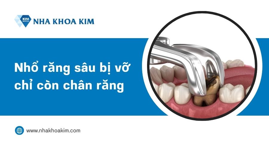 nhổ răng sâu vỡ