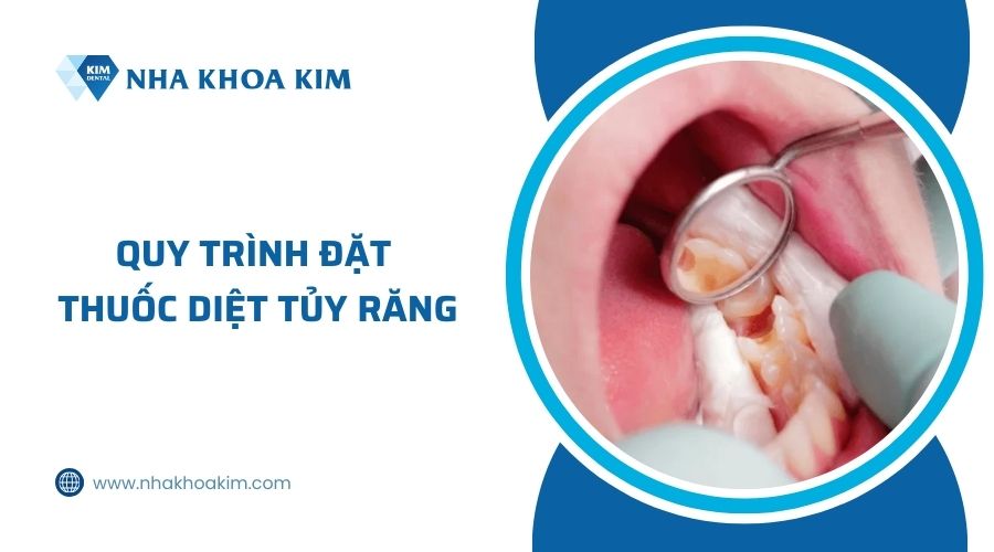 quy trình đặt thuốc diệt tủy răng