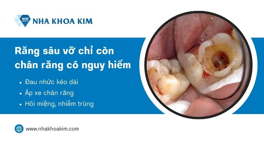 Răng sâu vỡ chỉ còn chân răng có nguy hiểm không?