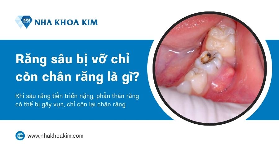 răng sâu vỡ chỉ còn chân răng là gì?