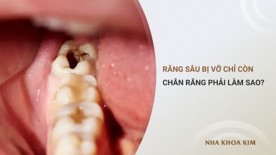 Răng sâu bị vỡ chỉ còn chân răng phải làm sao?