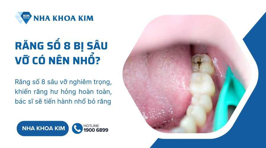 Răng khôn bị sâu vỡ có nên nhổ bỏ không?