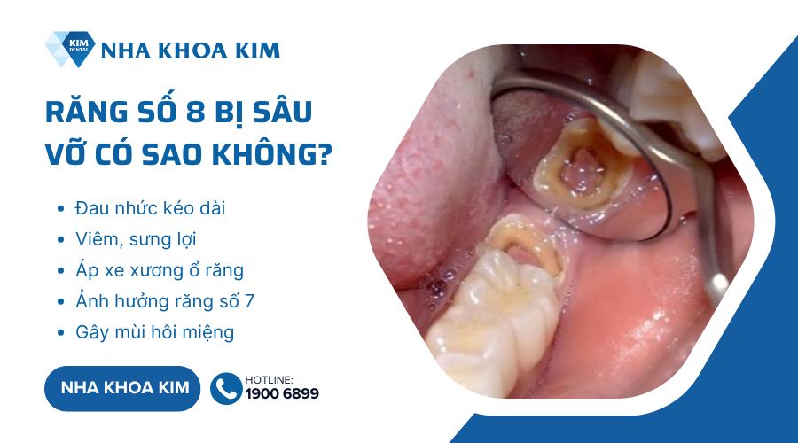 Răng số 8 sâu vỡ có sao không?