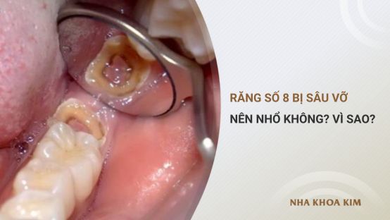 Răng Số 8 Bị Sâu Vỡ Có Nên Nhổ Không? Vì Sao?