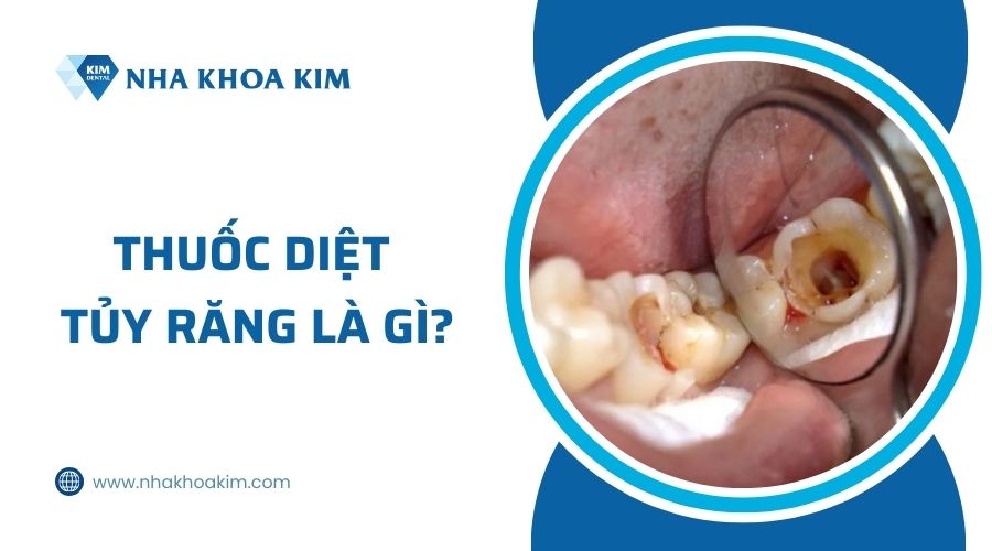 thuốc diệt tủy răng là gì?