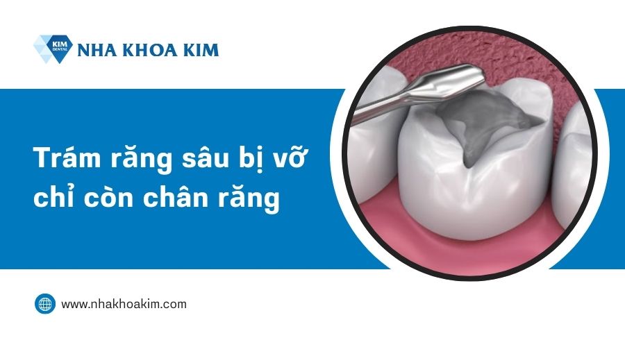 điều trị răng sâu vỡ chỉ còn lại chân răng bằng cách trám răng