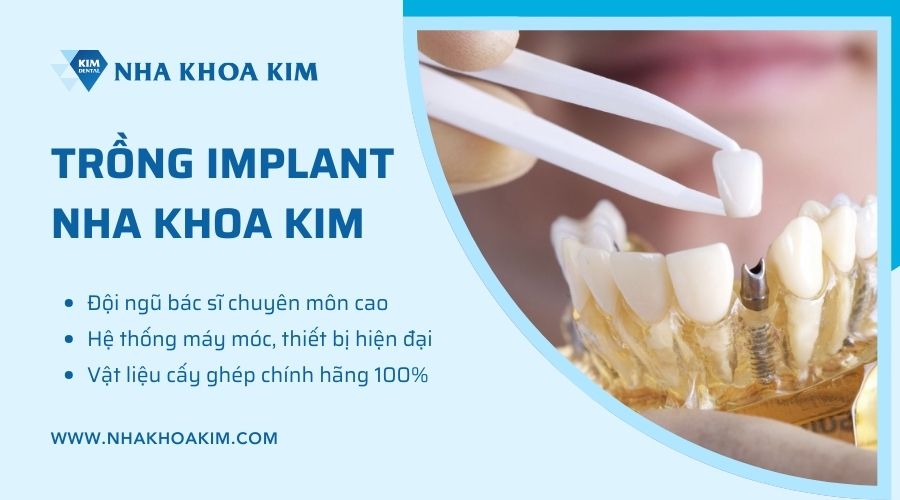 Trồng Implant nha khoa ở đâu uy tín?