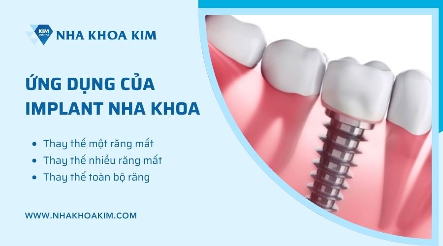 ứng dụng của răng implant nha khoa