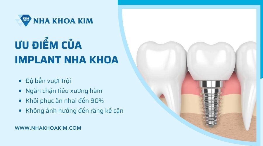 ưu điểm của implant nha khoa 